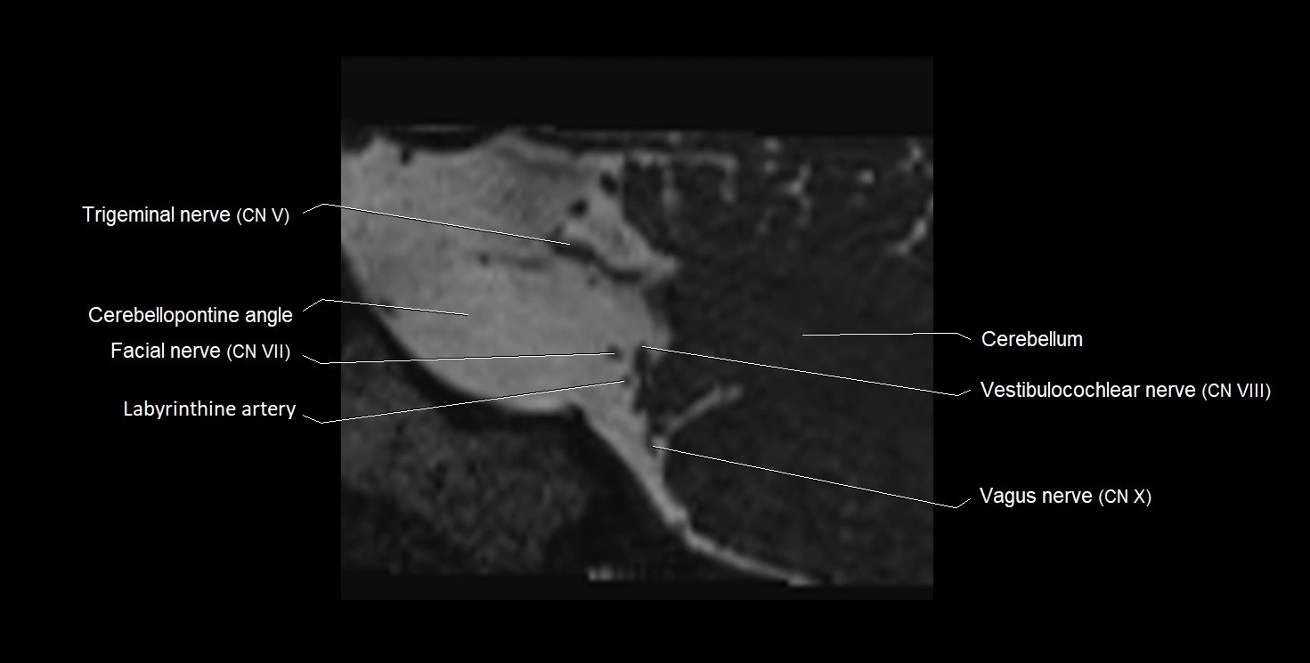Internal auditory meatus (IAM) 3T sagittal cross sectional anatomy image 41.webp